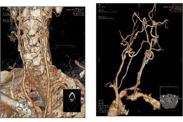 Компьютерная томография (КТ) артерий шеи